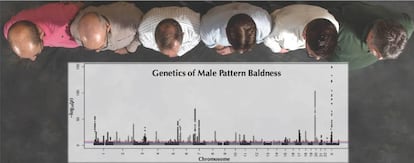 Padrões genéticos da calvície em homens.