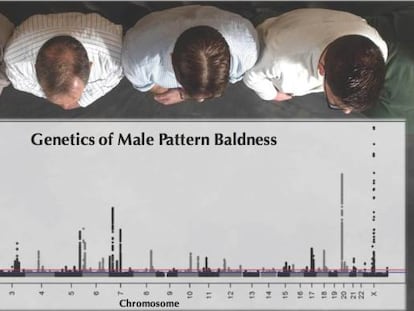 Padrões genéticos da calvície em homens.