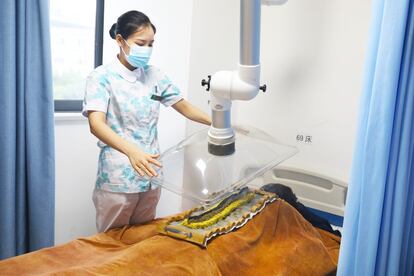 Una paciente en China, durante una sesión de Moxibustión, en una imagen de archivo.