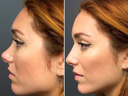 Así se ‘opera’ la nariz sin pasar por el quirófano