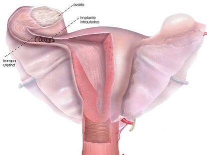 Esquema de la ubicación del dispositivo de esterilización en la trompa de Falopio.