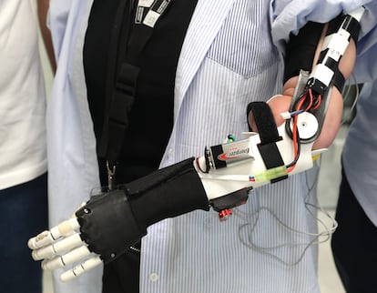 Los electrodos de la prótesis utilizan la energía eléctrica de dos músculos del brazo para abrir y cerrar la mano.