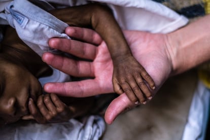 Un niño de nueve meses que sufre desnutrición severa aguda duerme en una cuna del hospital.