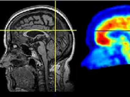 La combinación de técnicas de neuroimagen, como resonancia magnética y tomografía por emisión de positrones, permite un diagnóstico más fiable de los procesos neurodegenerativos.