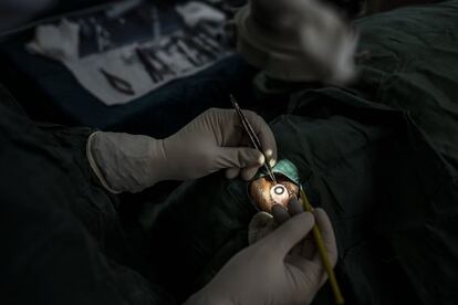 El doctor Assane procede a eliminar una catarata de un ojo como parte de las campañas de cirugía para esta dolencia que acercan la atención ocular a los distritos y las zonas más remotas de la provincia. Estas rondas de operaciones se celebran al menos tres veces al año.