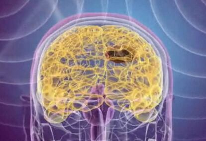 Ilustración de la terapia Magforce con nanopartículas magnéticas para tumores cerebrales.