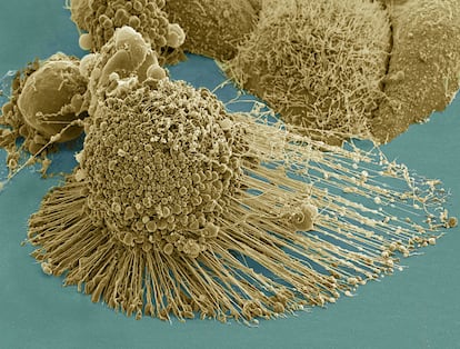 Células do câncer vistas com um microscópio eletrônico.