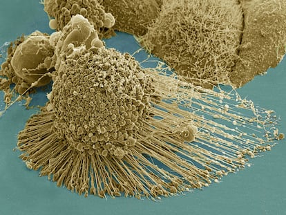 Células del cáncer vistas con microscopio electrónico.