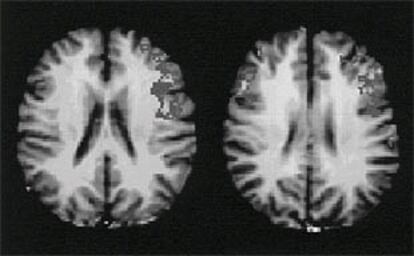 Imágenes de un cerebro de hombre (a la izquierda) y otro de mujer.