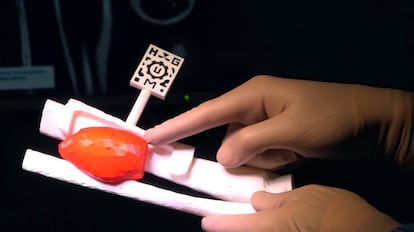 Reconstrucción en 3D del tumor que se operó mediante la nueva técnica. Se ve el marcador que sirve para sincronizar la información virtual con la realidad.