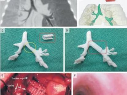 Un bebé salva la vida gracias a una prótesis creada con una impresora 3D