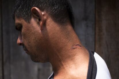 Elio Cabrera, también campesino de Guahory (Paraguay), muestra una herida en el cuello hecha por los policías.