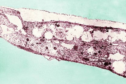 <p><strong>Síntomas (ambos sexos):</strong> la causa una bacteria llamada<em> treponema pallidum</em> y los síntomas que provoca son chanco sifilítico (úlcera), diseminación exantema cutáneo (erupción), así como en fases tardías, alteraciones neurológicas y cardiovasculares.</p> <p><strong>Tratamiento: </strong>antibióticos para ambos.</p> <p>Tanto para los casos de sífilis como del resto de enfermedades de transmisión sexual los expertos recomiendan abstenerse de mantener relaciones sexuales mientras se esté tomando el tratamiento y haya lesiones.</p>