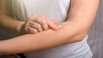 Cremas para urticaria en la piel