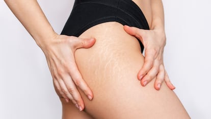 Reduce la aparición de estrías con esta crema. GETTY IMAGES.