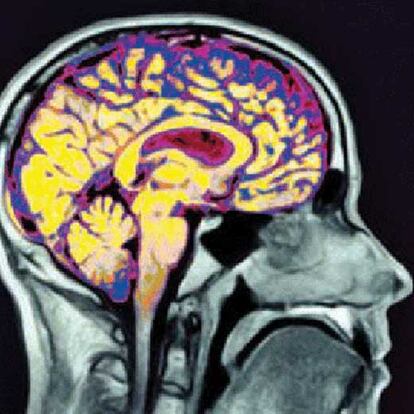 Imagen del cerebro en funcionamiento.