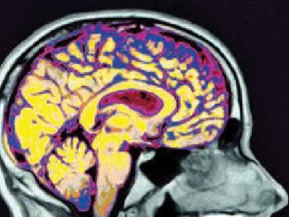 Imagen del cerebro en funcionamiento.