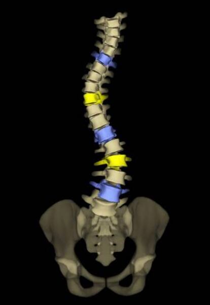 Las radiografías 2D y 3D son fundamentales para detectar problemas de columna como la escoliosis (Foto: Instituto Clavel).