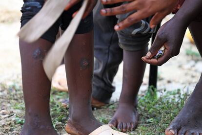 Alrededor del 80% de las personas afectadas por la enfermedad del pian son menores de 15 años. En al fotografía se pueden ver las piernas de niños afectados.