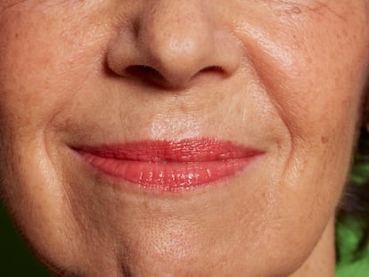 El melasma es la mancha que aparece en la zona del labio superior.