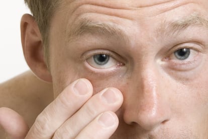 <p>La razón para tirarlas es sencilla: <strong>la lente de contacto puede contener microorganismos de la conjuntivitis adheridos</strong>. De manera que si se vuelven a usar es muy probable volver a contagiarse. En las no desechables, "deben ser desinfectadas con soluciones profesionales. No sirven las que se usan diariamente", comenta Villa Collar. "En algunas infecciones el oftalmólogo puede incluso indicar un cultivo de la lente para determinar con exactitud de qué patógeno se trata", añade González Manrique.</p>