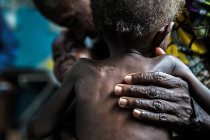 Un niño malnutrido de 17 meses en el centro de salud de Ditekemena (RDC).