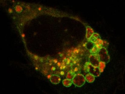 Célula de melanoma tras tratamiento con análogo de RNA viral.