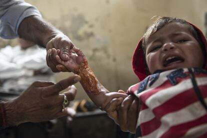 La mayoría de los cien pacientes que cada día se acercan a la tienda de dulces son niños que se queman con el fuego de las hogueras en invierno y barreños de agua o aceite hirviendo.