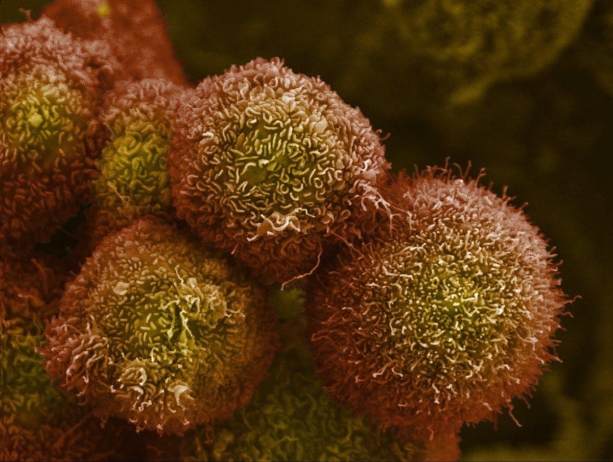 Autoestopist Vaccine: Cancer Treatment Results in 25 Patients