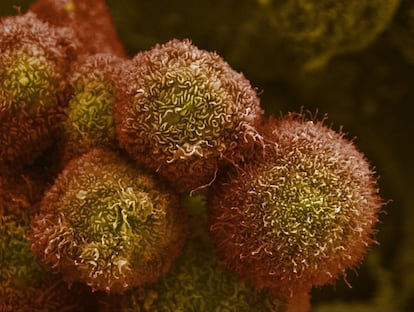 Células de cáncer de páncreas cultivadas en el laboratorio, observadas con un microscopio electrónico.