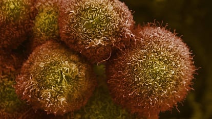Células de cáncer de páncreas cultivadas en el laboratorio, observadas con un microscopio electrónico.