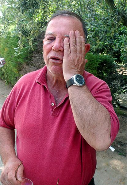 Joan Borràs muestra sus heridas tras sufrir el asalto de su casa.