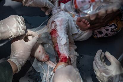 Doctores reemplazan las gasas en la herida de una niña a las afueras de un hospital en Palu. 