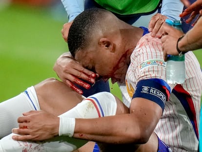 Kylian Mbappé, el lunes tras sufrir un golpe en la nariz en el partido de Francia contra Austria en Düsseldorf.