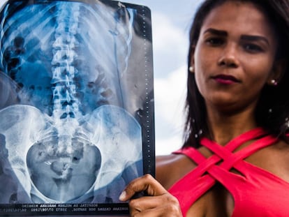 Adriana Caldas dos Santos com o exame que mostra as molas do Essure