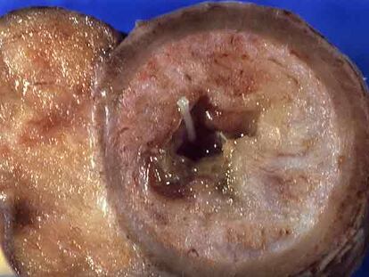 Corte transversal de un intestino delgado. La larva de anisakis, de color blanco, se puede apreciar en el centro de la imagen.