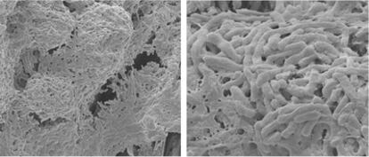 Imágenes de piedras de vesícula biliar de un portador de fiebre tifoidea asintomática, tomadas por microscopía electrónica, en las que se observan las microcolonias bacterianas de salmonela recubriendo los cálculos.