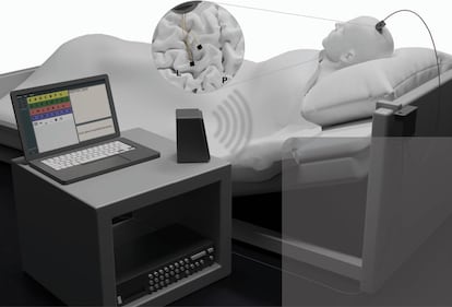 Representación esquemática del implante y la interfaz para deletrear con el ordenador.