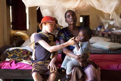 Bestida, con su pequeño Ezekiel, está en Kabanga por Angela, su hija albina. Las madres se hacen cargo de sus hijos y también son “guardianas” de otros niños albinos que han sido abandonados en el centro de manera que todos reciban algo de atención.
