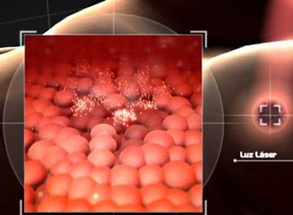 Esquema de tratamiento de un tumor con láser.