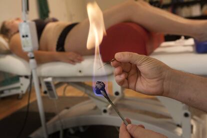 Un terapeuta calienta una aguja para estimular estimular los puntos de acupuntura.