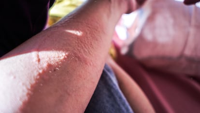 El brazo de un hombre con erupciones cutáneas.