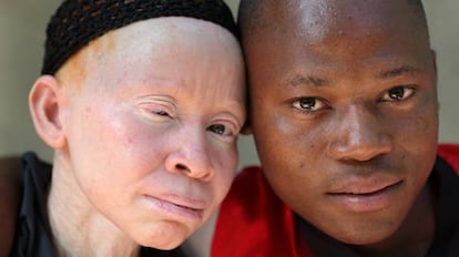 A la izquierda, una persona albina.