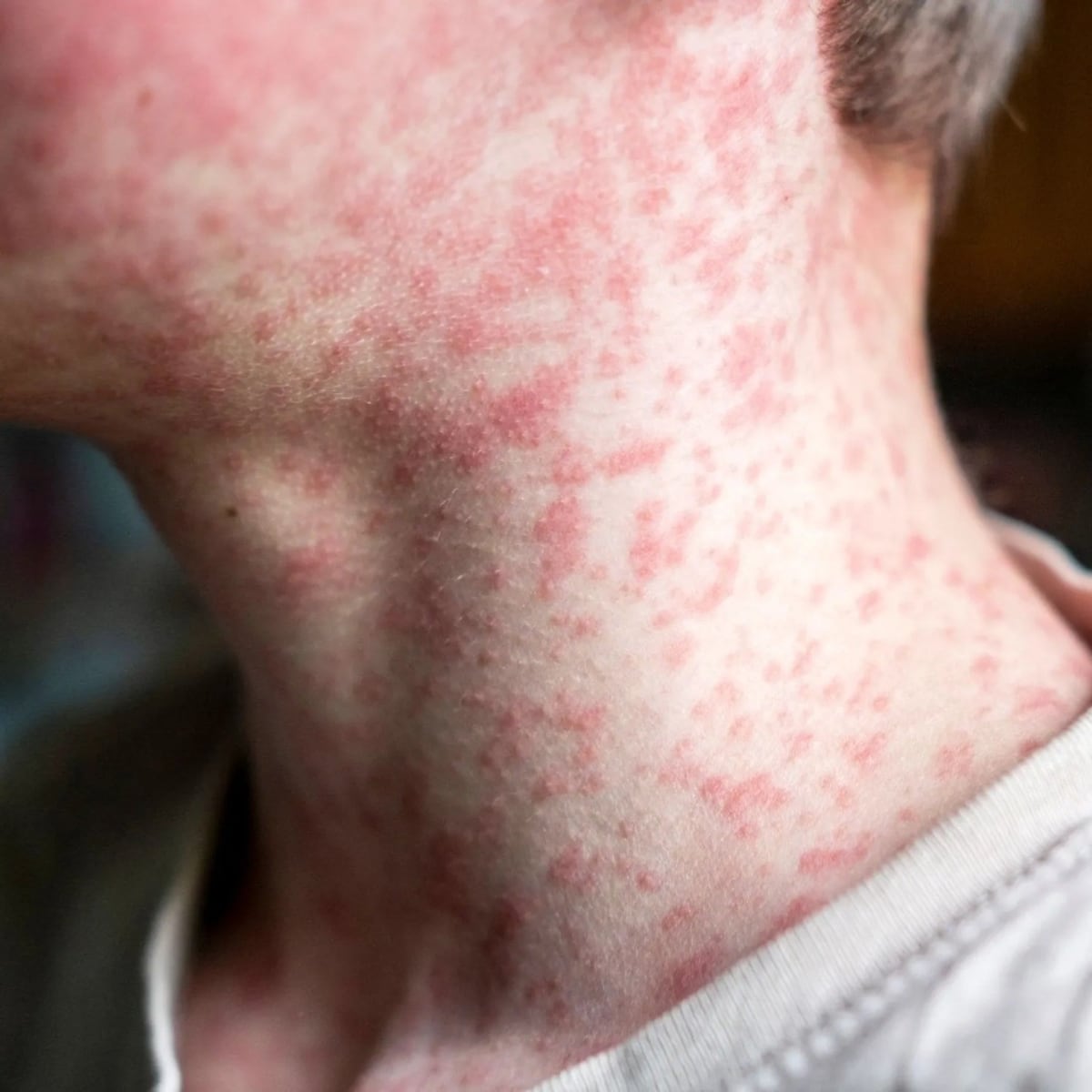 Measles Deaths Rising: What’s Happening & Why