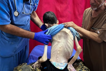 Un joven palestino, de 25 años, con severos síntomas de malnutrición, en al-Awda Hospital de Nuseirat Camp