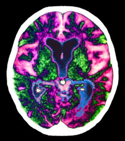 Cerebro dañado por el alzhéimer.