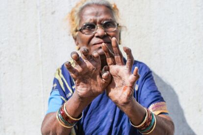 Jaibai Gaikowad, de 70 años, contrajo lepra hace 15, cuando aun se tardaba en detectar y tratar. Mensualmente atiende sesiones de fisioterapia en la clínica de Lok Seva Sangam en el centro de Bombay.