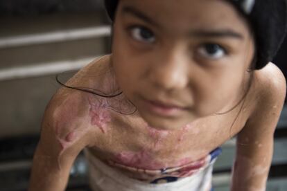 Una niña muestra las quemaduras que ya han cicatrizado después de un mes de tratamiento en la tienda de dulces de Jawahar.
