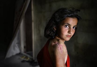 FILE -- In this May 29, 2014, file photo, Lujain Hourani, 11, a Syrian refugee girl who lost part of her shoulder in a government forces airstrike in the Syrian village of Zara, near Homs, stands outside her family room, at a collective center where many Syrian refugees live, in Kirbet Daoud village in Akkar north Lebanon. The U.N. agency for children says more than 80 percent of Syria's children have been harmed by the five-year-old conflict, including growing numbers forced to work, join armed groups or marry young because of widening poverty. (AP Photo/Hussein Malla, File)