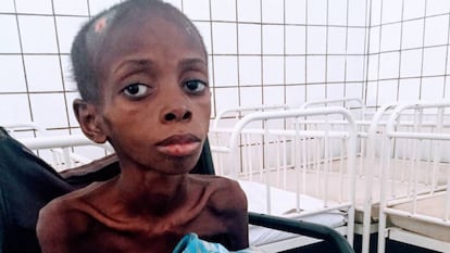 Marcos Daniel, de 10 años, en el hospital municipal Nossa Senhora da Paz en Cubal (Angola).